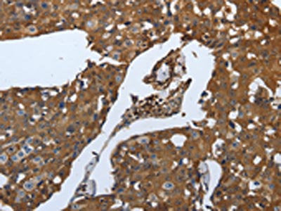 The image on the left is immunohistochemistry of paraffin-embedded Human breast cancer tissue using CSB-PA140842(SLC34A2 Antibody) at dilution 1/70, on the right is treated with synthetic peptide. (Original magnification: ×200)