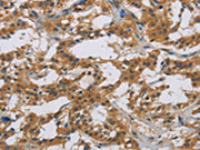 The image is immunohistochemistry of paraffin-embedded Human thyroid cancer tissue using CSB-PA140943(IL18R1 Antibody) at dilution 1/40. (Original magnification: ×200)