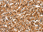The image on the left is immunohistochemistry of paraffin-embedded Human thyroid cancer tissue using CSB-PA140978(DDX4 Antibody) at dilution 1/40, on the right is treated with synthetic peptide. (Original magnification: ×200)
