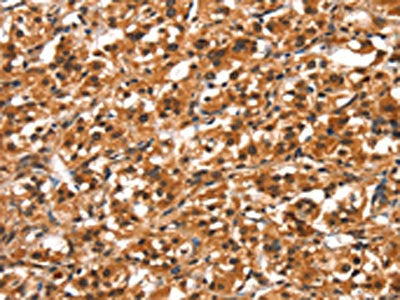 The image on the left is immunohistochemistry of paraffin-embedded Human thyroid cancer tissue using CSB-PA140978(DDX4 Antibody) at dilution 1/40, on the right is treated with synthetic peptide. (Original magnification: ×200)