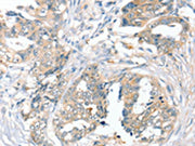 The image on the left is immunohistochemistry of paraffin-embedded Human cervical cancer tissue using CSB-PA140998(SLC9A9 Antibody) at dilution 1/45, on the right is treated with synthetic peptide. (Original magnification: ×200)