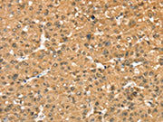 The image on the left is immunohistochemistry of paraffin-embedded Human liver cancer tissue using CSB-PA141242(RASSF9 Antibody) at dilution 1/40, on the right is treated with fusion protein. (Original magnification: ×200)