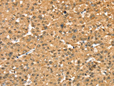 The image on the left is immunohistochemistry of paraffin-embedded Human liver cancer tissue using CSB-PA141242(RASSF9 Antibody) at dilution 1/40, on the right is treated with fusion protein. (Original magnification: ×200)