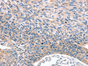 The image on the left is immunohistochemistry of paraffin-embedded Human esophagus cancer tissue using CSB-PA141385(MUC1 Antibody) at dilution 1/35, on the right is treated with synthetic peptide. (Original magnification: ×200)