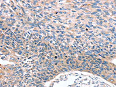 The image on the left is immunohistochemistry of paraffin-embedded Human esophagus cancer tissue using CSB-PA141385(MUC1 Antibody) at dilution 1/35, on the right is treated with synthetic peptide. (Original magnification: ×200)