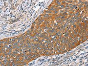 The image on the left is immunohistochemistry of paraffin-embedded Human cervical cancer tissue using CSB-PA141533(HSPB8 Antibody) at dilution 1/45, on the right is treated with fusion protein. (Original magnification: ×200)