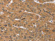 The image on the left is immunohistochemistry of paraffin-embedded Human liver cancer tissue using CSB-PA141671(KCNJ15 Antibody) at dilution 1/40, on the right is treated with synthetic peptide. (Original magnification: ×200)