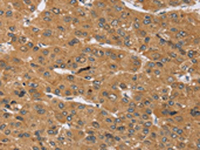 The image on the left is immunohistochemistry of paraffin-embedded Human liver cancer tissue using CSB-PA141671(KCNJ15 Antibody) at dilution 1/40, on the right is treated with synthetic peptide. (Original magnification: ×200)