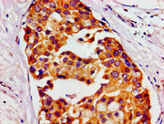 Immunohistochemistry of paraffin-embedded human breast cancer using CSB-PA14189A0Rb at dilution of 1:100