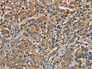 The image on the left is immunohistochemistry of paraffin-embedded Human liver cancer tissue using CSB-PA142000(NANOS2 Antibody) at dilution 1/30, on the right is treated with fusion protein. (Original magnification: ×200)