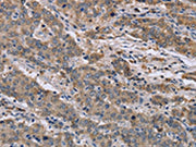 The image on the left is immunohistochemistry of paraffin-embedded Human liver cancer tissue using CSB-PA142038(GSN Antibody) at dilution 1/40, on the right is treated with synthetic peptide. (Original magnification: ×200)