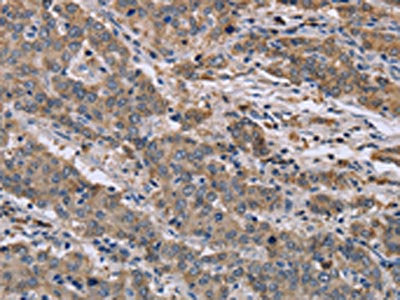 The image on the left is immunohistochemistry of paraffin-embedded Human liver cancer tissue using CSB-PA142038(GSN Antibody) at dilution 1/40, on the right is treated with synthetic peptide. (Original magnification: ×200)