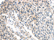 The image on the left is immunohistochemistry of paraffin-embedded Human lung cancer tissue using CSB-PA142299(IQGAP2 Antibody) at dilution 1/40, on the right is treated with synthetic peptide. (Original magnification: ×200)