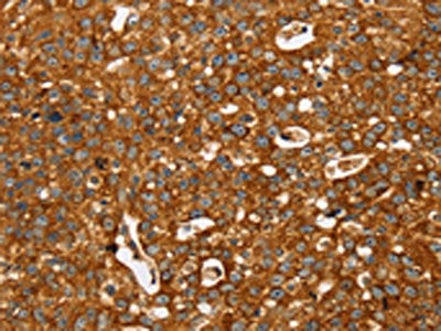 The image on the left is immunohistochemistry of paraffin-embedded Human breast cancer tissue using CSB-PA142345(STK32A Antibody) at dilution 1/35, on the right is treated with synthetic peptide. (Original magnification: ×200)