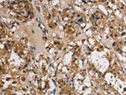 The image on the left is immunohistochemistry of paraffin-embedded Human thyroid cancer tissue using CSB-PA142614(UBE2S Antibody) at dilution 1/40, on the right is treated with fusion protein. (Original magnification: ×200)