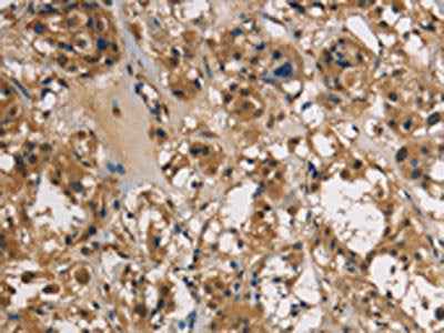 The image on the left is immunohistochemistry of paraffin-embedded Human thyroid cancer tissue using CSB-PA142614(UBE2S Antibody) at dilution 1/40, on the right is treated with fusion protein. (Original magnification: ×200)
