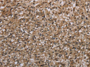 The image on the left is immunohistochemistry of paraffin-embedded Human prostate cancer tissue using CSB-PA142898(MYO18B Antibody) at dilution 1/20, on the right is treated with synthetic peptide. (Original magnification: ×200)