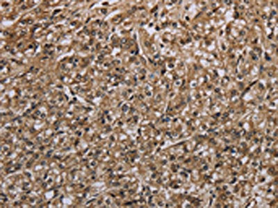 The image on the left is immunohistochemistry of paraffin-embedded Human prostate cancer tissue using CSB-PA142898(MYO18B Antibody) at dilution 1/20, on the right is treated with synthetic peptide. (Original magnification: ×200)