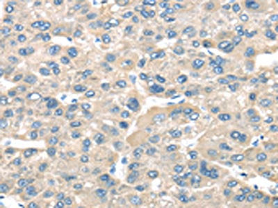 The image on the left is immunohistochemistry of paraffin-embedded Human liver cancer tissue using CSB-PA142964(TNFAIP8 Antibody) at dilution 1/35, on the right is treated with fusion protein. (Original magnification: ×200)