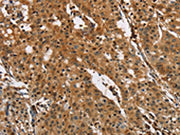 The image on the left is immunohistochemistry of paraffin-embedded Human gastic cancer tissue using CSB-PA142965(PTK6 Antibody) at dilution 1/40, on the right is treated with fusion protein. (Original magnification: ×200)