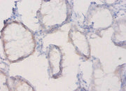 Immunohistochemistry of paraffin-embedded human colon cancer using CSB-PA14309A0Rb at dilution of 1:20