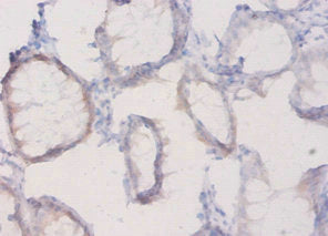 Immunohistochemistry of paraffin-embedded human colon cancer using CSB-PA14309A0Rb at dilution of 1:20