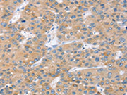 The image on the left is immunohistochemistry of paraffin-embedded Human liver cancer tissue using CSB-PA143150(SLC27A2 Antibody) at dilution 1/20, on the right is treated with fusion protein. (Original magnification: ×200)