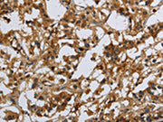 The image on the left is immunohistochemistry of paraffin-embedded Human thyroid cancer tissue using CSB-PA143153(CMTM8 Antibody) at dilution 1/40, on the right is treated with synthetic peptide. (Original magnification: ×200)