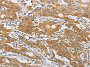 The image on the left is immunohistochemistry of paraffin-embedded Human gastic cancer tissue using CSB-PA143333(FARSB Antibody) at dilution 1/20, on the right is treated with fusion protein. (Original magnification: ×200)
