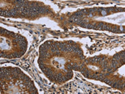 The image on the left is immunohistochemistry of paraffin-embedded Human colon cancer tissue using CSB-PA143390(FHIT Antibody) at dilution 1/30, on the right is treated with fusion protein. (Original magnification: ×200)