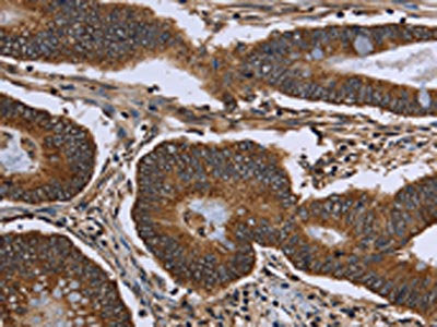 The image on the left is immunohistochemistry of paraffin-embedded Human colon cancer tissue using CSB-PA143390(FHIT Antibody) at dilution 1/30, on the right is treated with fusion protein. (Original magnification: ×200)