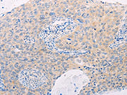 The image on the left is immunohistochemistry of paraffin-embedded Human cervical cancer tissue using CSB-PA143673(MAP3K12 Antibody) at dilution 1/25, on the right is treated with fusion protein. (Original magnification: ×200)