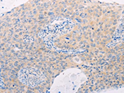 The image on the left is immunohistochemistry of paraffin-embedded Human cervical cancer tissue using CSB-PA143673(MAP3K12 Antibody) at dilution 1/25, on the right is treated with fusion protein. (Original magnification: ×200)