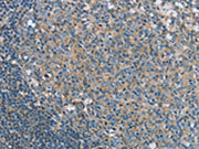 The image on the left is immunohistochemistry of paraffin-embedded Human tonsil tissue using CSB-PA143756(SNX15 Antibody) at dilution 1/20, on the right is treated with fusion protein. (Original magnification: ×200)