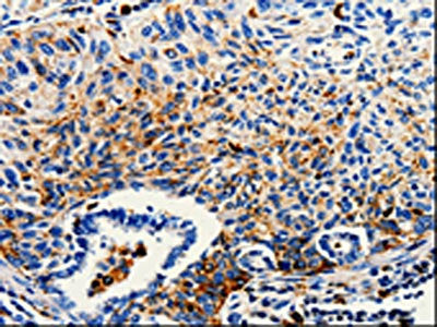 The image on the left is immunohistochemistry of paraffin-embedded Human lung cancer tissue using CSB-PA144023(CTSZ Antibody) at dilution 1/25, on the right is treated with fusion protein. (Original magnification: ×200)