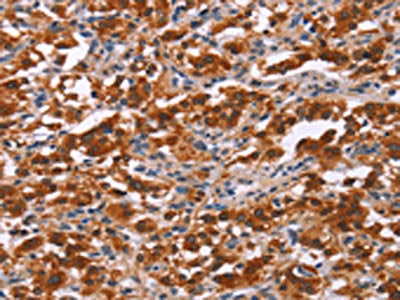 The image on the left is immunohistochemistry of paraffin-embedded Human thyroid cancer tissue using CSB-PA144089(PAX9 Antibody) at dilution 1/25, on the right is treated with synthetic peptide. (Original magnification: ×200)