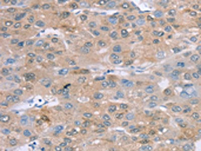 The image on the left is immunohistochemistry of paraffin-embedded Human liver cancer tissue using CSB-PA144328(SULT2B1 Antibody) at dilution 1/20, on the right is treated with fusion protein. (Original magnification: ×200)