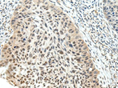 The image on the left is immunohistochemistry of paraffin-embedded Human esophagus cancer tissue using CSB-PA144842(NSD1 Antibody) at dilution 1/25, on the right is treated with synthetic peptide. (Original magnification: ×200)