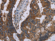 The image on the left is immunohistochemistry of paraffin-embedded Human colon cancer tissue using CSB-PA144936(CLDND1 Antibody) at dilution 1/40, on the right is treated with fusion protein. (Original magnification: ×200)