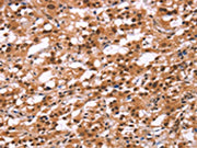 The image on the left is immunohistochemistry of paraffin-embedded Human thyroid cancer tissue using CSB-PA145013(HIPK1 Antibody) at dilution 1/25, on the right is treated with synthetic peptide. (Original magnification: ×200)