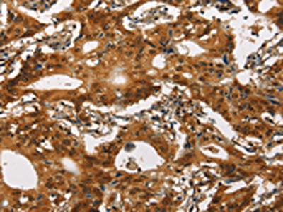 The image on the left is immunohistochemistry of paraffin-embedded Human gastic cancer tissue using CSB-PA145166(CACNA1C Antibody) at dilution 1/30, on the right is treated with synthetic peptide. (Original magnification: ×200)