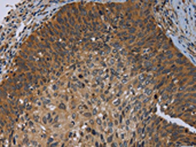 The image on the left is immunohistochemistry of paraffin-embedded Human cervical cancer tissue using CSB-PA145264(PRKD3 Antibody) at dilution 1/50, on the right is treated with synthetic peptide. (Original magnification: ×200)