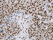 The image on the left is immunohistochemistry of paraffin-embedded Human breast cancer tissue using CSB-PA145306(ZMIZ1 Antibody) at dilution 1/20, on the right is treated with synthetic peptide. (Original magnification: ×200)