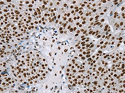 The image on the left is immunohistochemistry of paraffin-embedded Human breast cancer tissue using CSB-PA145306(ZMIZ1 Antibody) at dilution 1/20, on the right is treated with synthetic peptide. (Original magnification: ×200)
