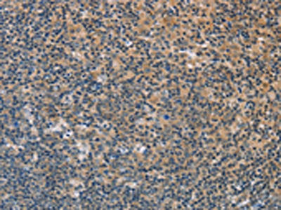 The image on the left is immunohistochemistry of paraffin-embedded Human tonsil tissue using CSB-PA145330(FXYD1 Antibody) at dilution 1/60, on the right is treated with fusion protein. (Original magnification: ×200)