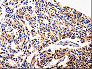 The image on the left is immunohistochemistry of paraffin-embedded Human lung cancer tissue using CSB-PA145342(AFP Antibody) at dilution 1/20, on the right is treated with fusion protein. (Original magnification: ×200)