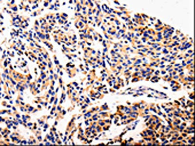 The image on the left is immunohistochemistry of paraffin-embedded Human lung cancer tissue using CSB-PA145342(AFP Antibody) at dilution 1/20, on the right is treated with fusion protein. (Original magnification: ×200)