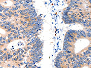 The image on the left is immunohistochemistry of paraffin-embedded Human colon cancer tissue using CSB-PA145350(LAT2 Antibody) at dilution 1/15, on the right is treated with fusion protein. (Original magnification: ×200)