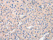 The image on the left is immunohistochemistry of paraffin-embedded Human liver cancer tissue using CSB-PA145433(CTSK Antibody) at dilution 1/20, on the right is treated with synthetic peptide. (Original magnification: ×200)