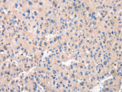 The image on the left is immunohistochemistry of paraffin-embedded Human liver cancer tissue using CSB-PA145433(CTSK Antibody) at dilution 1/20, on the right is treated with synthetic peptide. (Original magnification: ×200)
